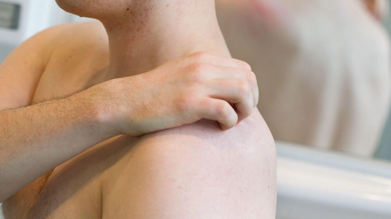 Dermatophilose, auch Regenfäule genannt, ist eine seltene, sexuell übertragbare Hautinfektion. (Foto: Friso Gentsch/dpa/dpa-tmn)