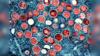 Die WHO ist besorgt über die mögliche Ausbreitung einer neuen Mpox-Sublinie  (Foto: National Institute of Allergy and Infectious Diseases/AP/dpa)