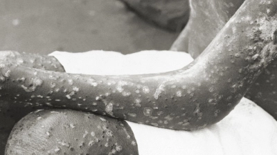 Die letzten Menschen erkrankten in den 60er und 70er Jahren an Pocken. Dank Impfprogrammen wurden sie ausgerottet. (Handout) (Foto: Robert C. Hogan/US-Gesundheitsbehörde CDC/dpa)