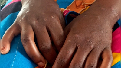 Mpox ist vor allem für kleine Kinder und immungeschwächte Menschen gefährlich (Archivbild) (Foto: Janvier Barhahiga/AP/dpa)