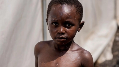 Für Kinder und immungeschwächte Menschen kann die Krankheit tödlich sein. (Archivbild) (Foto: Moses Sawasawa/AP/dpa)