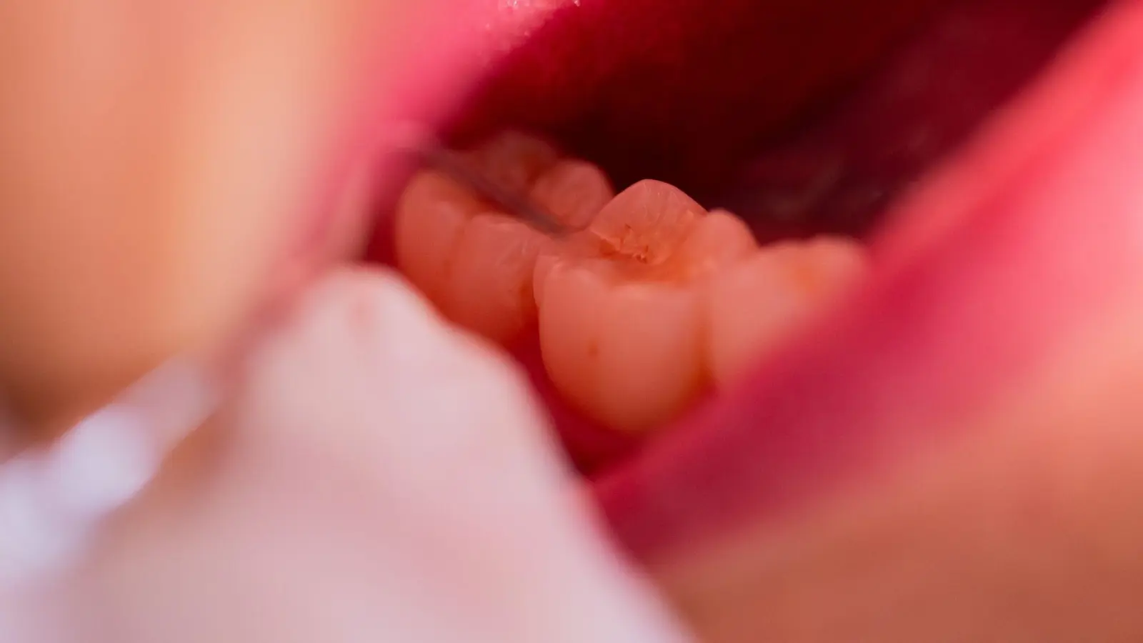 Nach einer Behandlung in einer Augsburger Zahnarztpraxis ist ein Patient gestorben. (Symbolbild) (Foto: Rolf Vennenbernd/dpa)